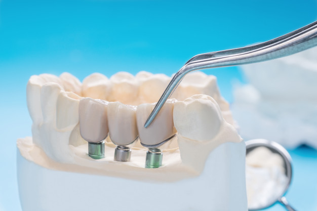 dental bridges or crowns in castor and stettler