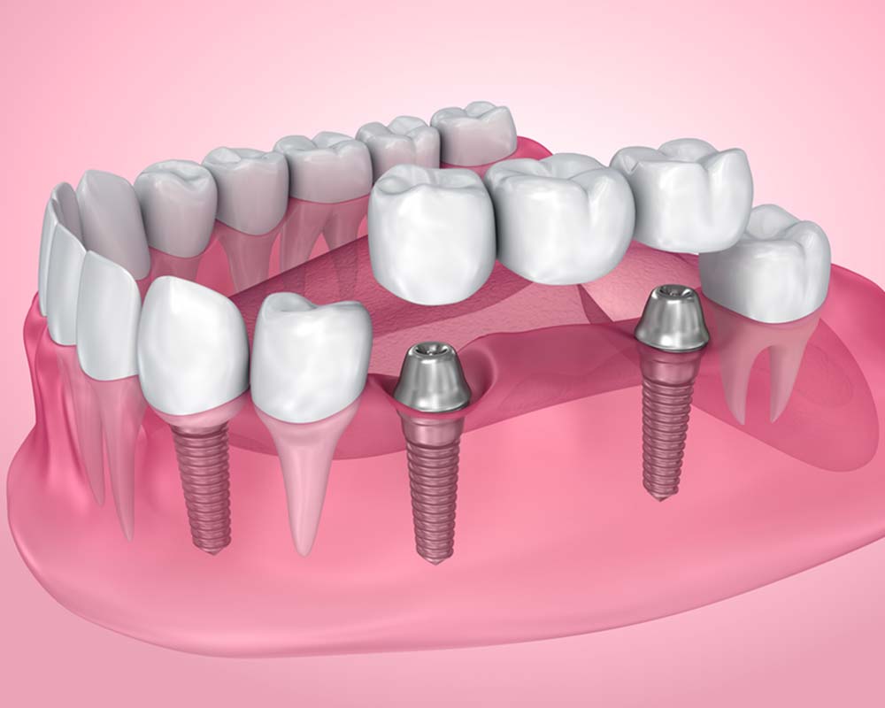 dental implants in castor and stettler