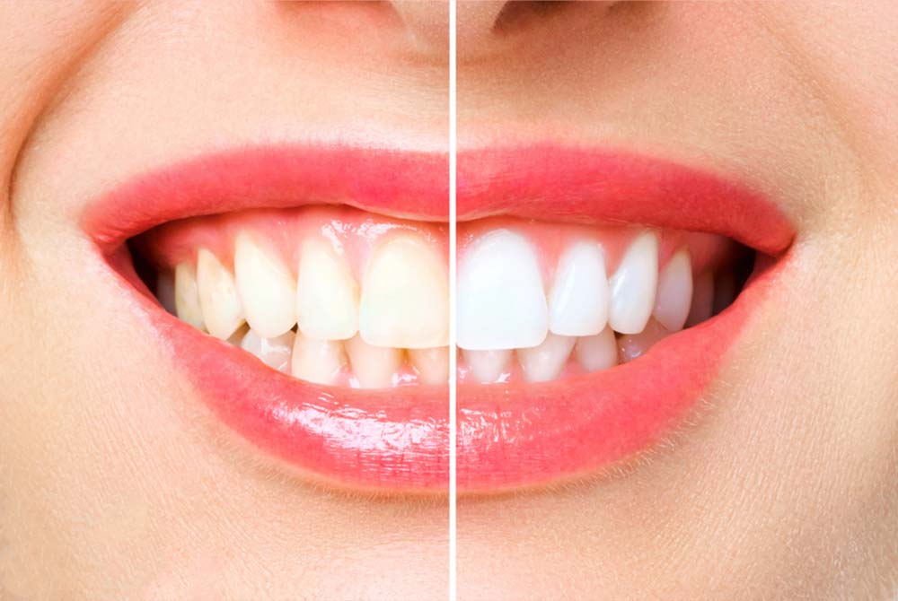 teeth whitening in castor and stettler